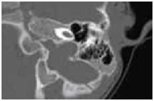 Congenital sensorineural hearing loss- A radiological (CT and MRI) study