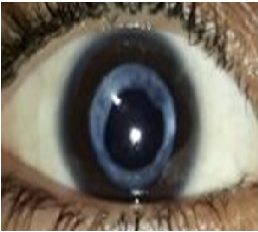 Visual outcome after ND: YA Glaser posterior capsulotomy in pseudophakic patient