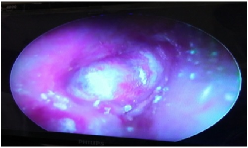Interlay myringoplasty: hearing gain and outcomein large central tympanic membrane perforation