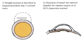 Modified Small Incision Cataract Surgery (SICS) for combined extraction: A comparison of pre-operative and post-operative intraocular pressure (IOP)