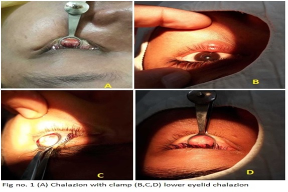 A comparison of intralesional triamcinolone acetonide injection and incision-curettage for chalazion treatment