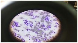 Chloroma of the orbit as a presenting feature of acute myeloid leukemia in a four year old female child